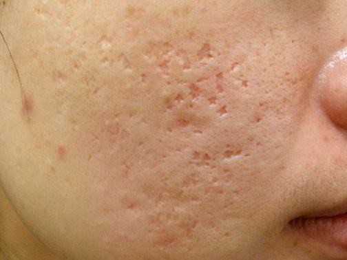 最新痘坑撫平神器，科技重塑肌膚之美，自信生活從此開始