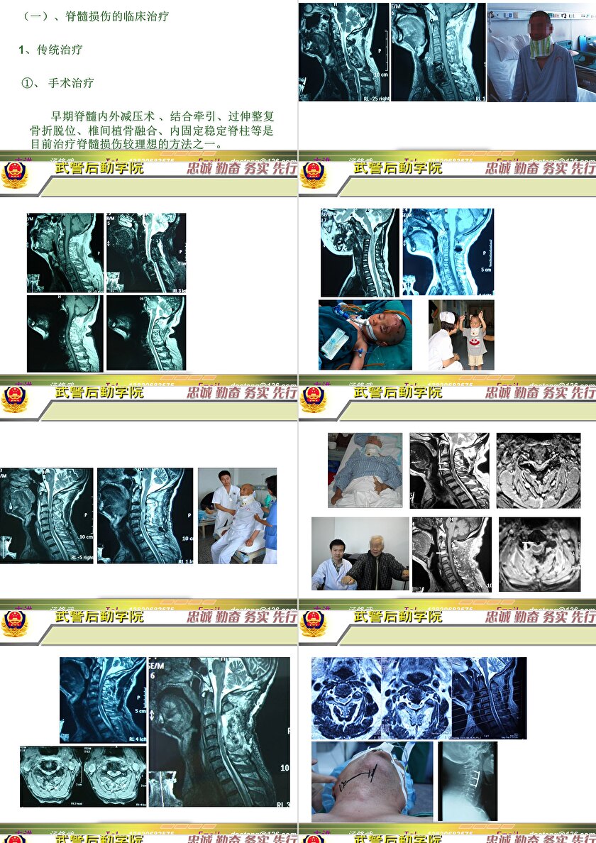 2023年脊髓損傷研究新進(jìn)展，里程碑式的突破與日常奇妙變化