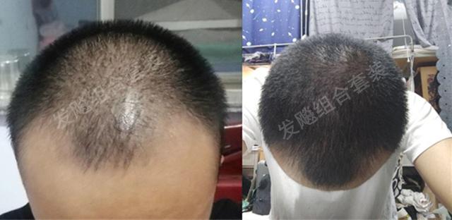 治愈脫發(fā)最新重大突破，重塑自信，希望之光再現(xiàn)