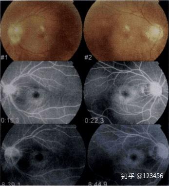 最新藥肺炎詳解，你需要知道的一切——健康小紅書