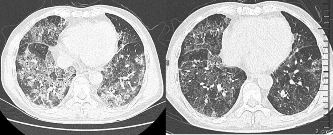 科技前沿高科技產品助力新冠心肺炎抗疫之路最新進展